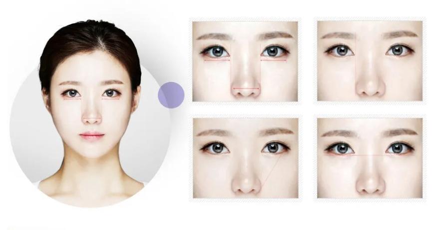 眼科可以割双眼皮吗,眼科医生为什么不建议做双眼皮