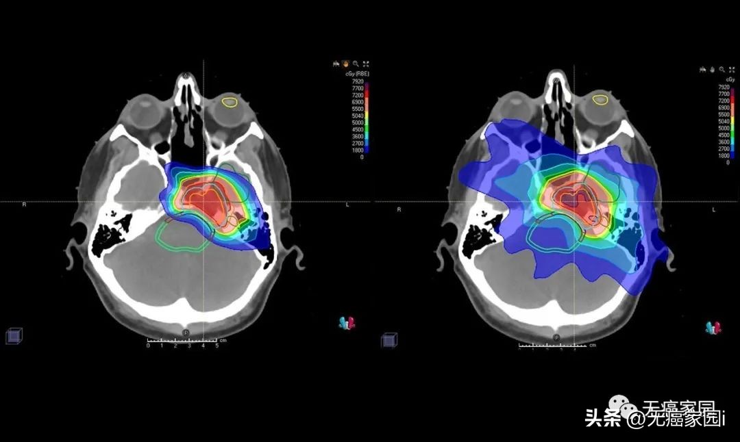 女足队长患癌症网上求救！专家建议质子治疗！这项技术有何优势？