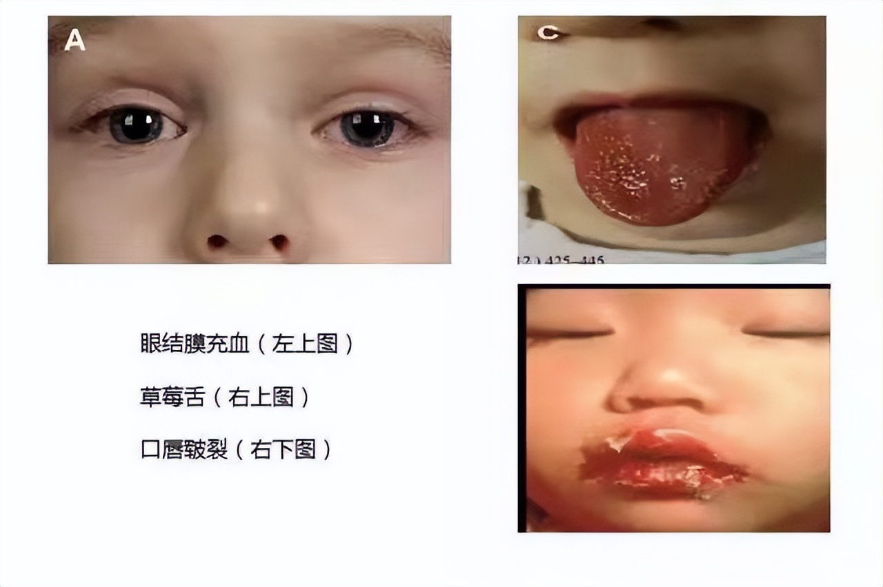 2岁新冠小孩发烧40度喝药不退,2岁宝宝发烧39度吃药不退
