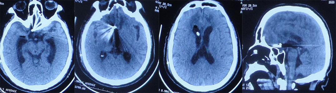 前交通动脉瘤破裂后开颅治疗风险,脑前交通动脉瘤破裂出血