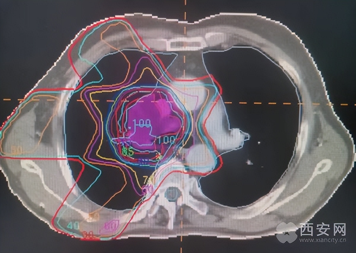 精准放疗能全部杀死癌细胞吗,早期肺癌可以用精准放疗吗