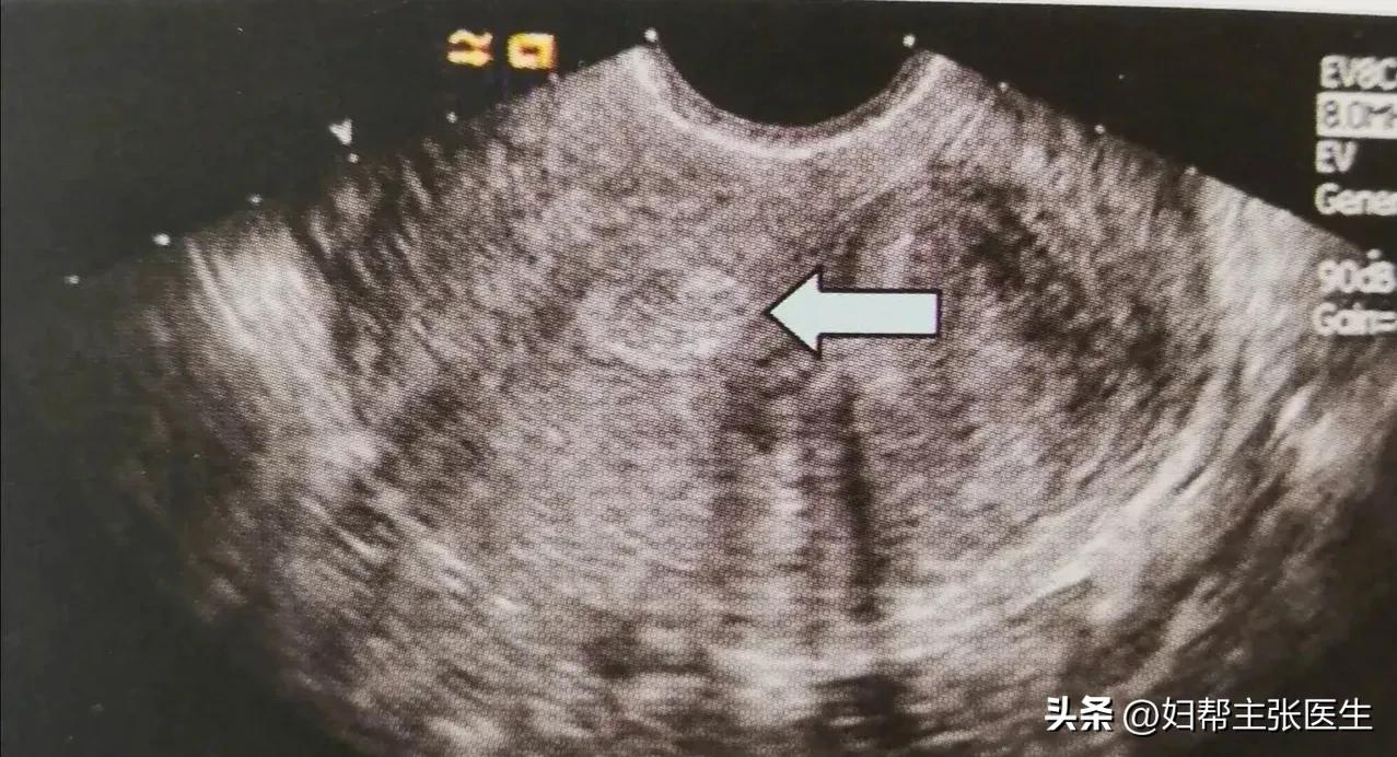 女子头晕意外查出癌症,女子意外查出癌症