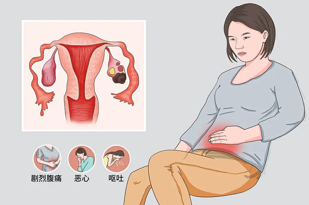 巧克力囊肿科普视频,卵巢巧克力囊肿最新治疗方法