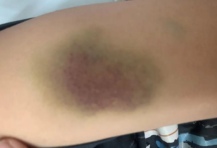 孩子身上出现成片小红点要警惕,儿童身上出现小红点是什么原因