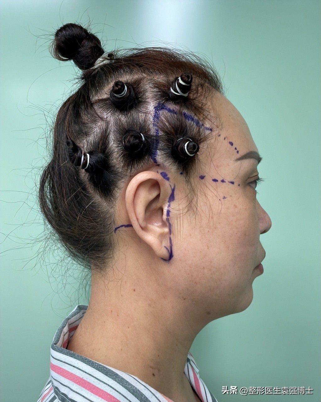 做拉皮手术前一定要明白这几点,医生不建议做拉皮手术