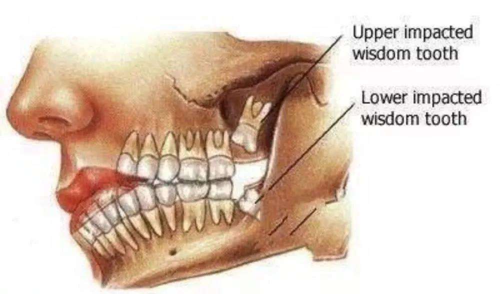 自从长了智齿，总是咬到腮帮子怎么办？专家：建议拔除