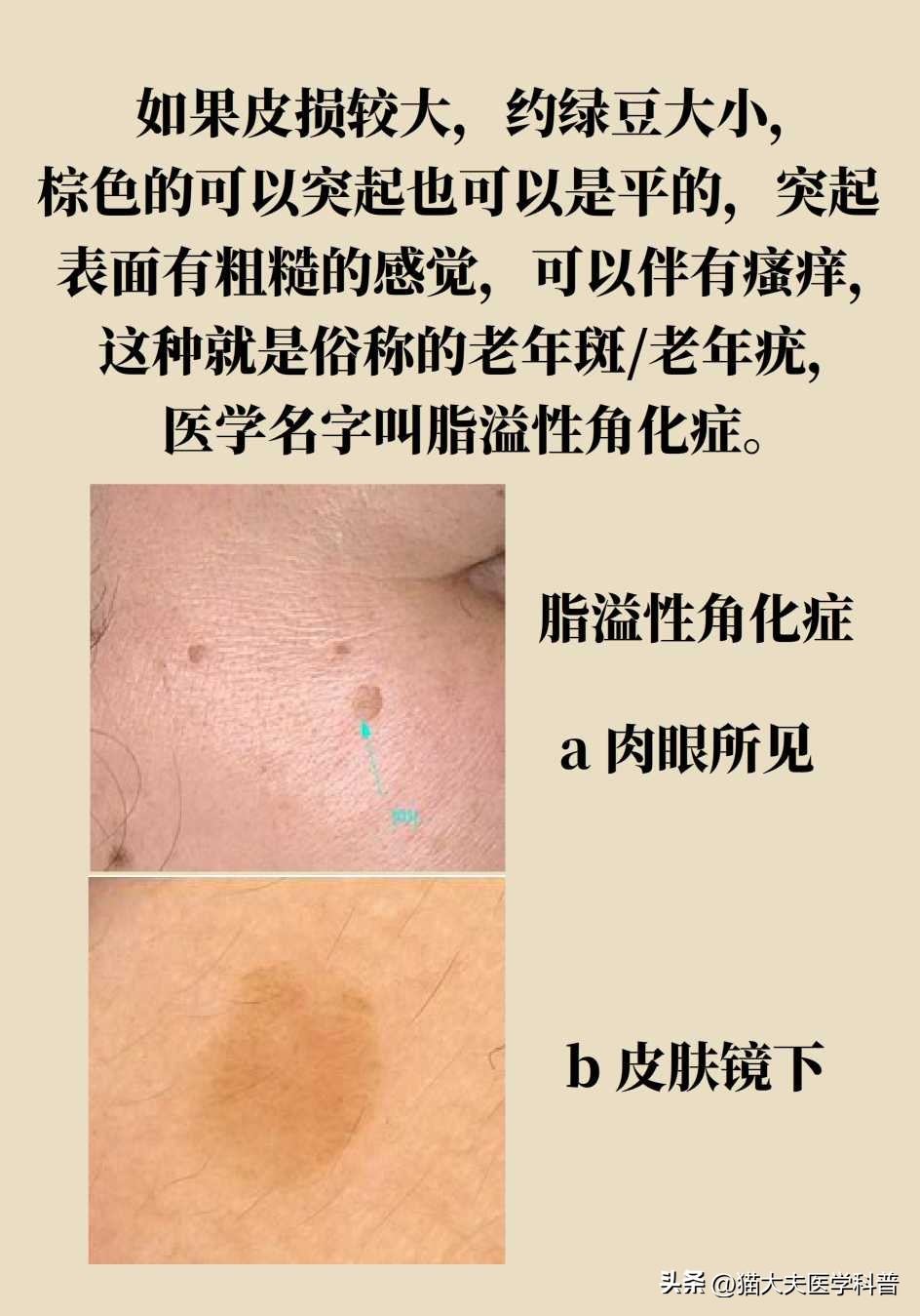 脖子上长的小肉揪怎么治啊,疣丝是不是脖子上的小肉粒