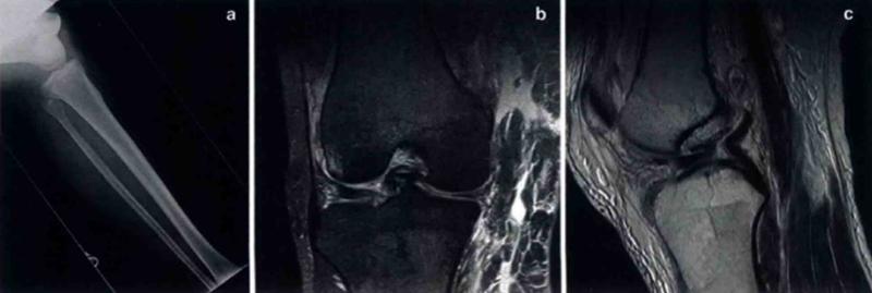 15岁初中跑步膝关节脱位怎样治疗,膝关节脱位的外科治疗