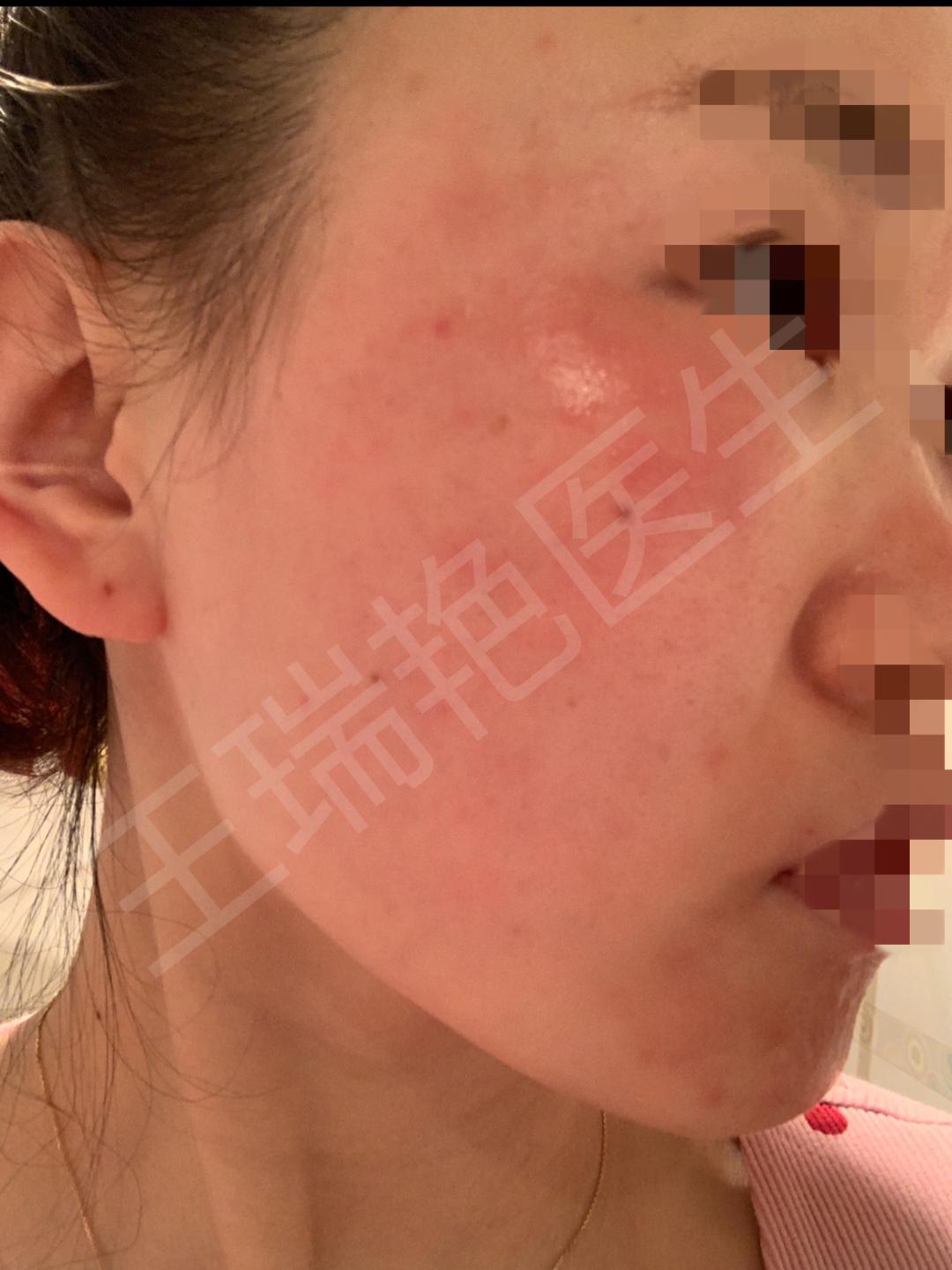 烂脸的警告,烂脸警告