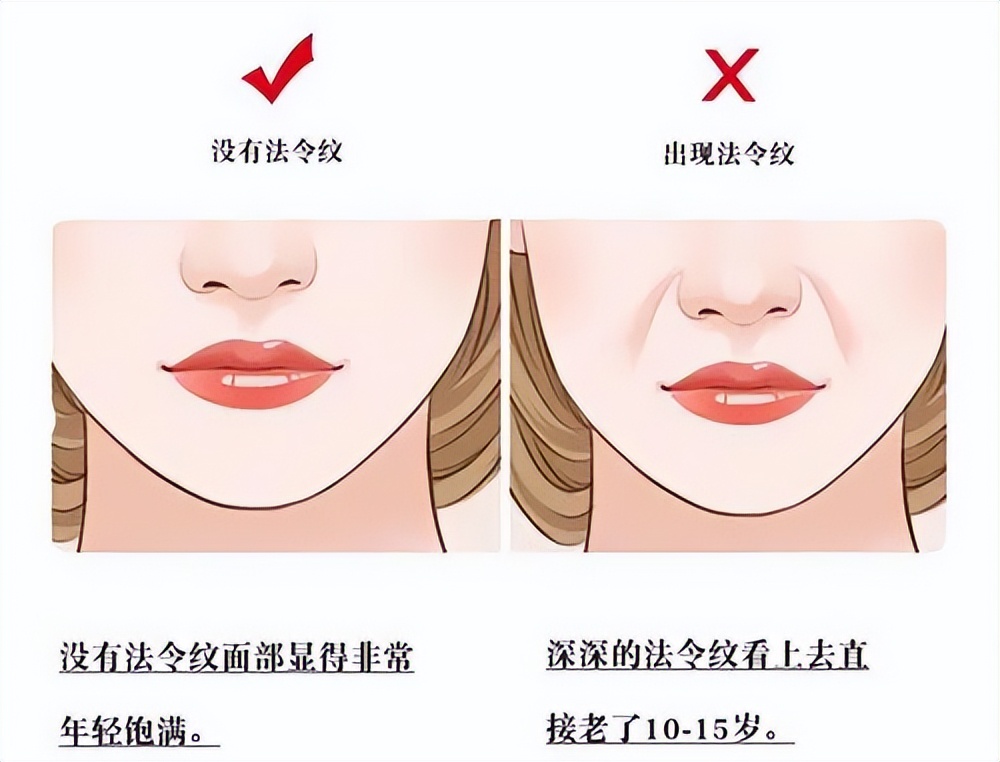 遗传的法令纹特别显老怎么办,眼睛泪沟和法令纹显老怎么办