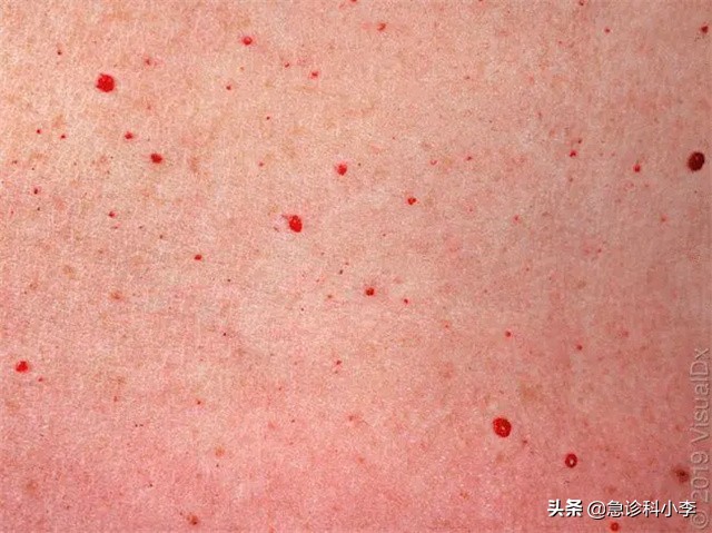 身上出现不痒的小红点是怎么回事,身上突然起了很多小红点不痛不痒