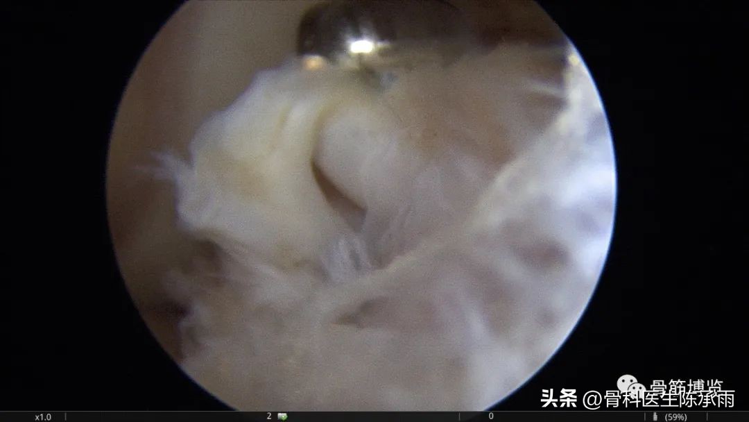 内侧半月板前角囊肿,关节镜下内侧半月板部分切除术