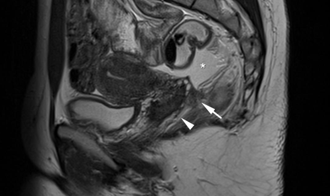MRI如何评估子宫内膜异位症？这10个病例会帮助您