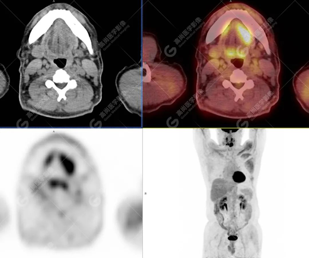 肺部结节确诊是癌如何治疗,肺结节疑似早期恶性肿瘤