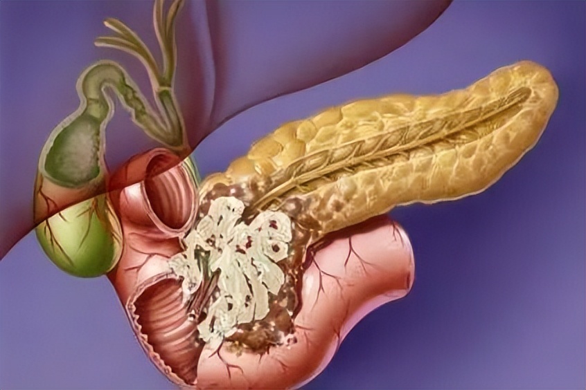 免疫细胞治疗胰腺癌,胰腺癌免疫治疗的研究进展