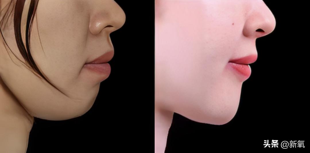 牙齿正畸和骨骼正畸的区别,牙齿正畸和眼轴增长有关系吗