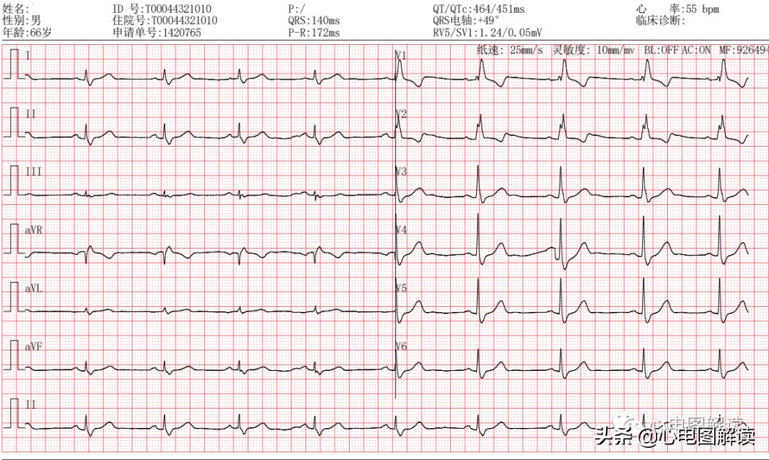 右束支阻滞qrs波形图解,右束支传导阻滞继发性st段改变