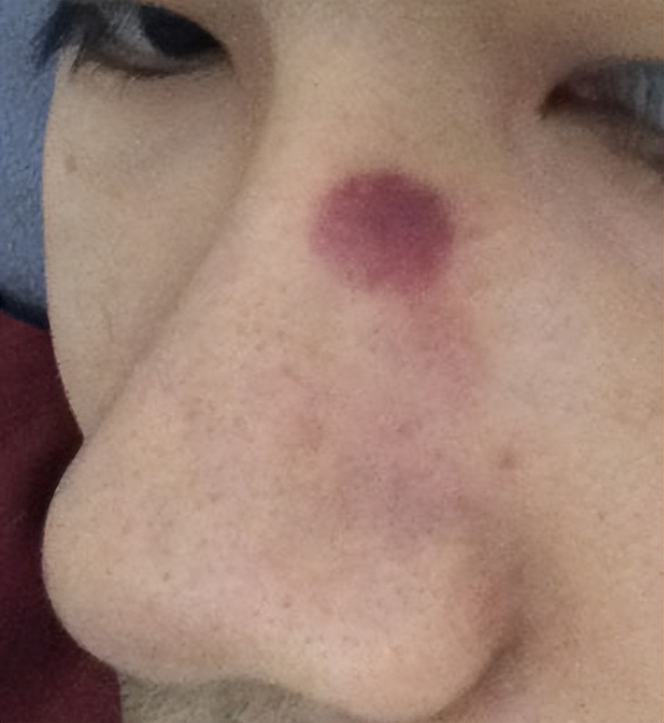 超微小气泡美容有用吗,美容院小气泡