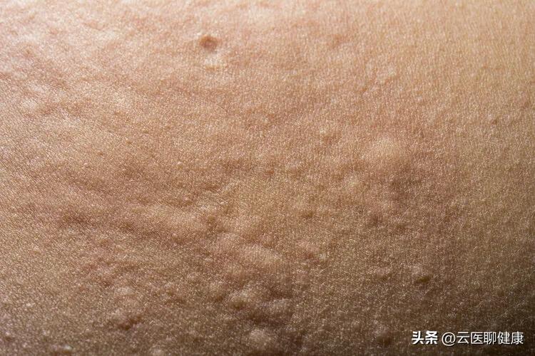 麻疹原因,麻疹由什么引起