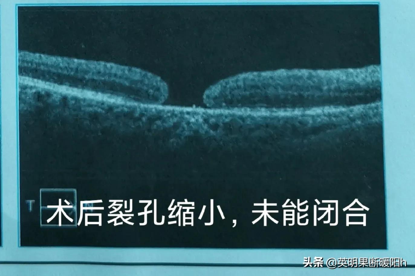 眼睛黄斑裂孔中医能治好吗怎么治,眼睛黄斑裂孔有什么症状