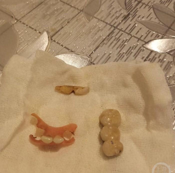 医疗事故牙齿误拔,医疗事故致死案例