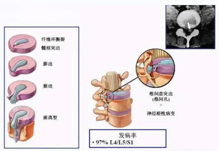 腰骶部僵硬疼痛，波及臀和大腿，可能腰突？一方补肾强骨，祛腰痛