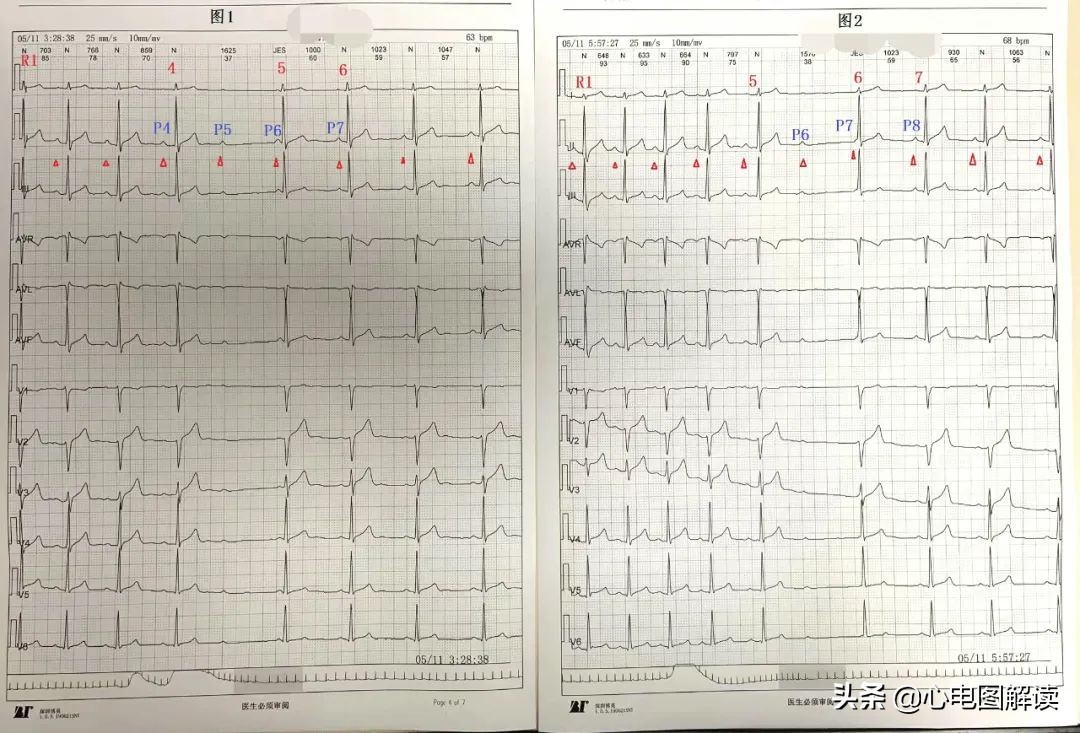 心电图rr间期长有危害吗,心电图短pr间期产生原因