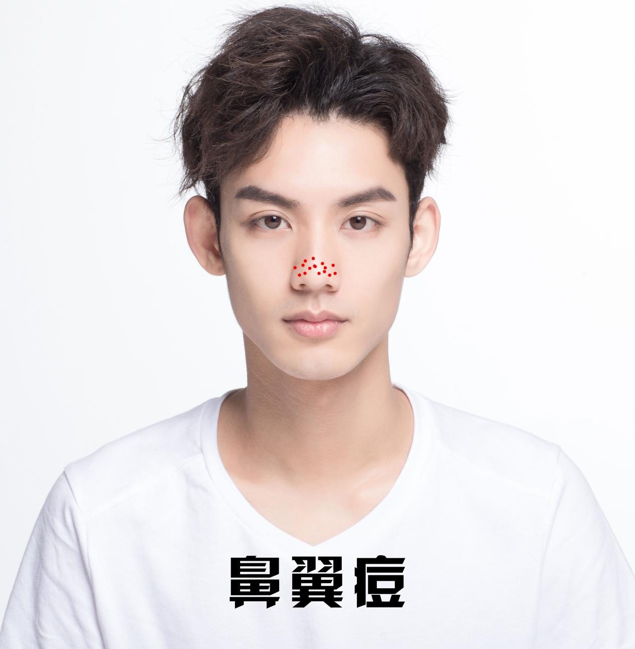 祛痘攻略图文,全网最好用的祛痘方法