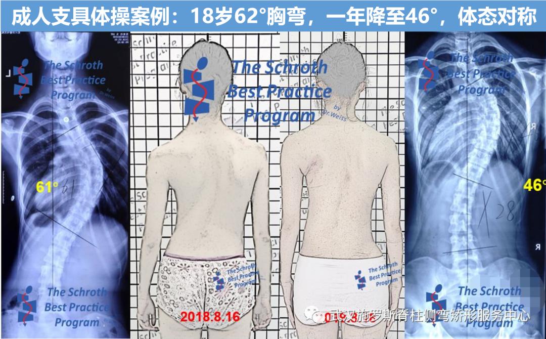 成人脊柱侧弯往哪弯,成年人脊柱侧弯怎么矫正
