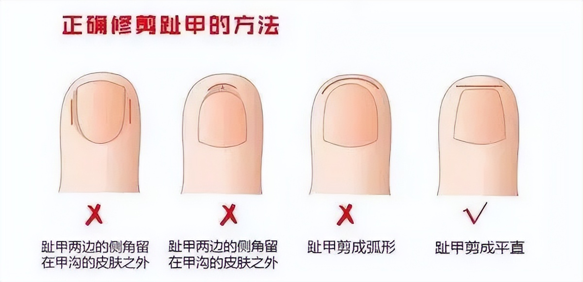 得了甲沟炎的正确处理方法,甲沟炎怎么改掉咬指甲的毛病