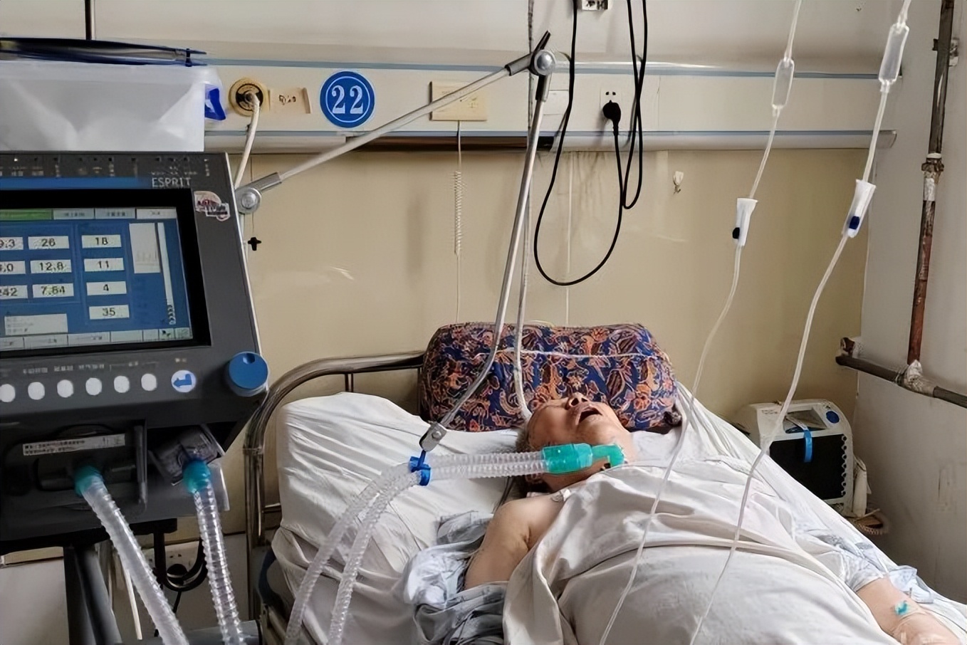 气管插管切开手术,气管切开术昏迷病人堵管