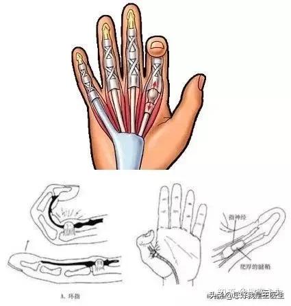 腱鞘炎中指咯吱响,腱鞘炎手腕疼痛咯嘣响