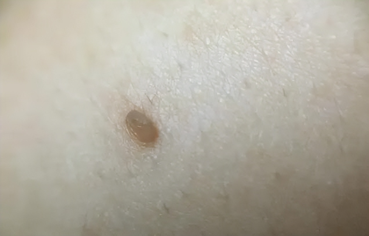 脖子上的小肉粒揪掉后会怎样,脖子上透明小肉粒可以揪下来