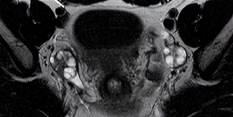 卵巢良性病变mri诊断思路,核磁共振可以看出卵巢病变吗
