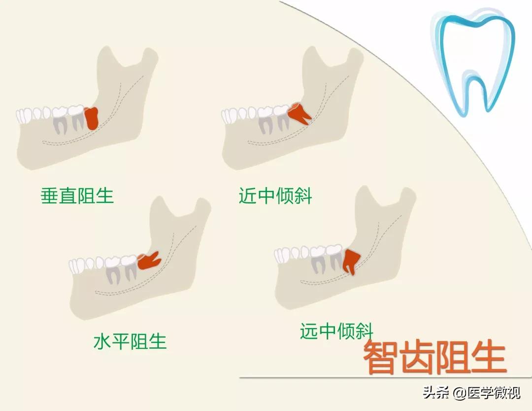 智齿摇晃厉害可以自己拔吗,拔智齿是硬把牙拽下来吗