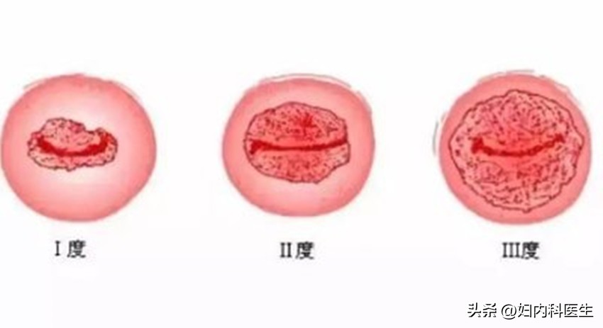 妇产科医生吓唬人,宫颈糜烂被医院吓唬说癌症