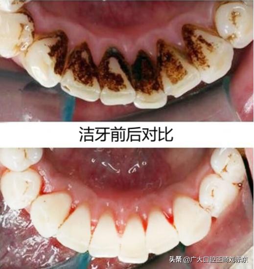 牙齿发黄变白用什么牙膏,牙齿发黄有牙垢怎么可以变白