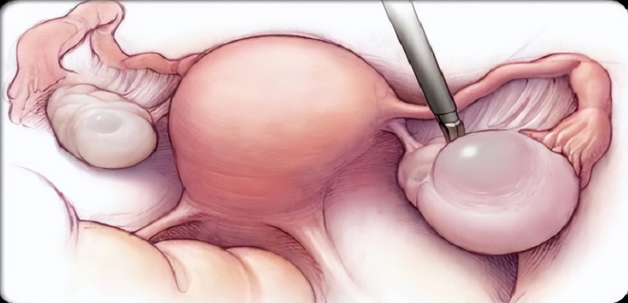 妇科宫腔镜和腹腔镜有什么区别,腹腔镜和宫腔镜的区别是什么