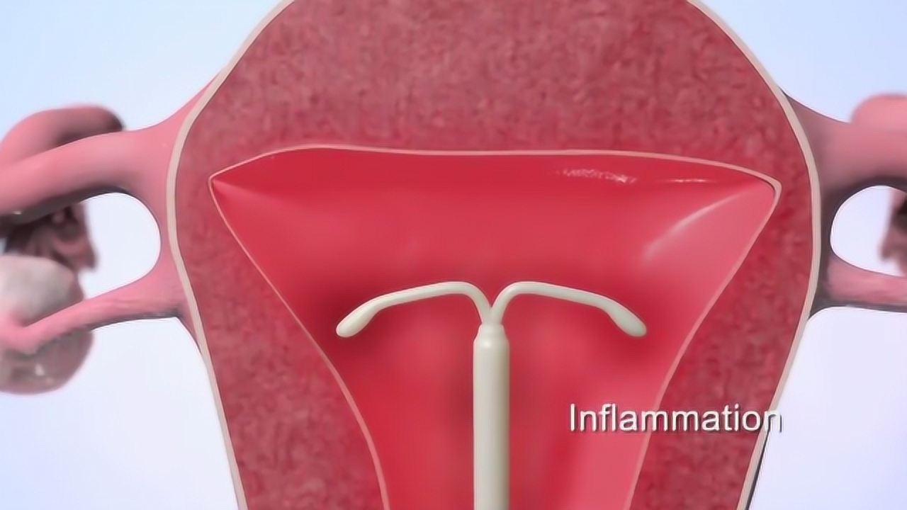 中国第一批“上环”的女性，医生直言：30年了，难逃出这4种结局