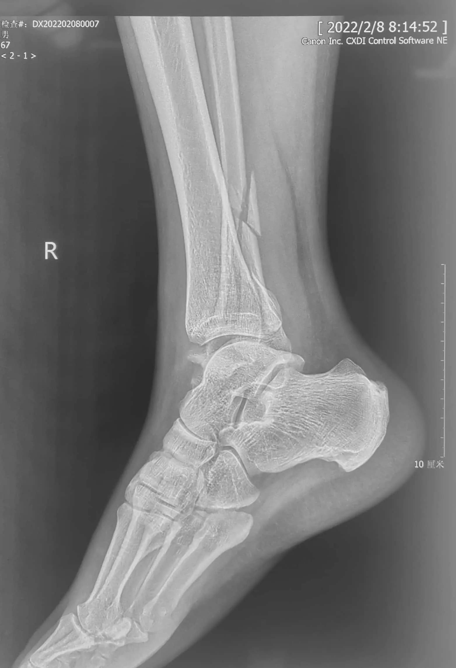 咋就不能先复一下位呢？手法复位就那么难吗？