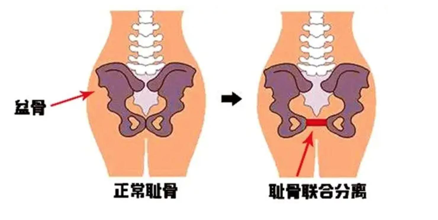 孕期耻骨疼怎么办？如何缓解？