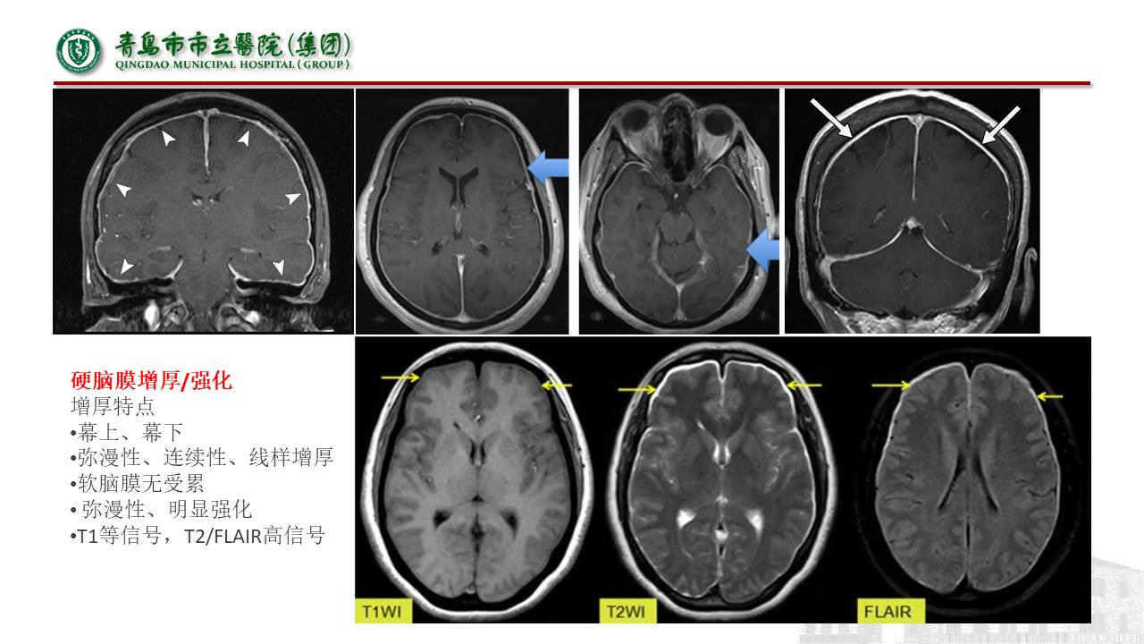 低颅压综合征耳闷,低颅压综合征吃什么药