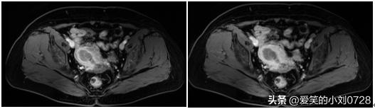 80岁老人子宫内膜癌腹腔镜,子宫内膜癌微创切除手术