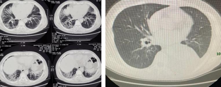 间质性肺炎肺腺癌能吃靶向药吗,肺腺癌靶向治疗配中药