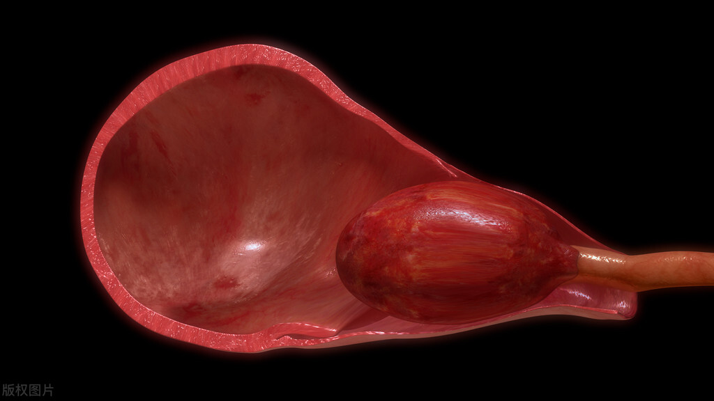 夫妻生活后突然剧烈腹痛，原来是黄体破裂，紧急手术保住卵巢