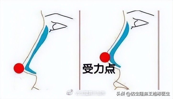 假体隆鼻耳软骨垫鼻尖图片,l型假体耳软骨隆鼻图片