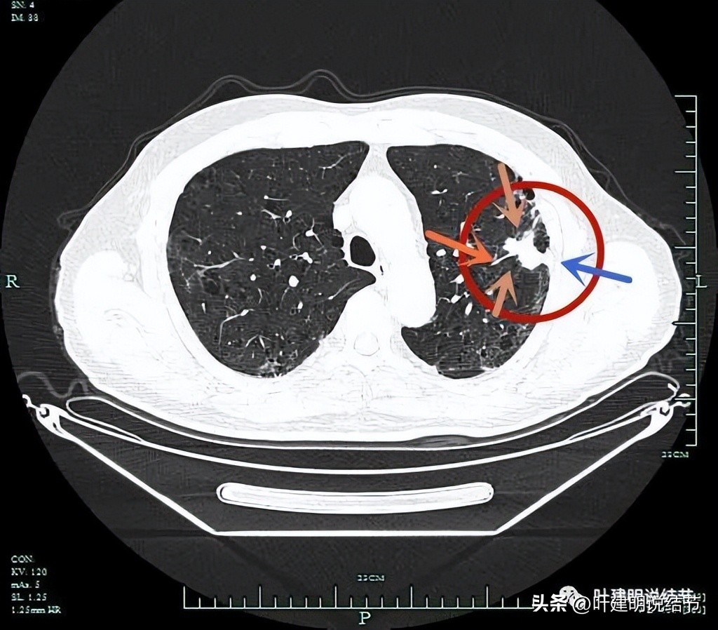 pet判断淋巴结转移,petct判断癌有没有转移准确吗