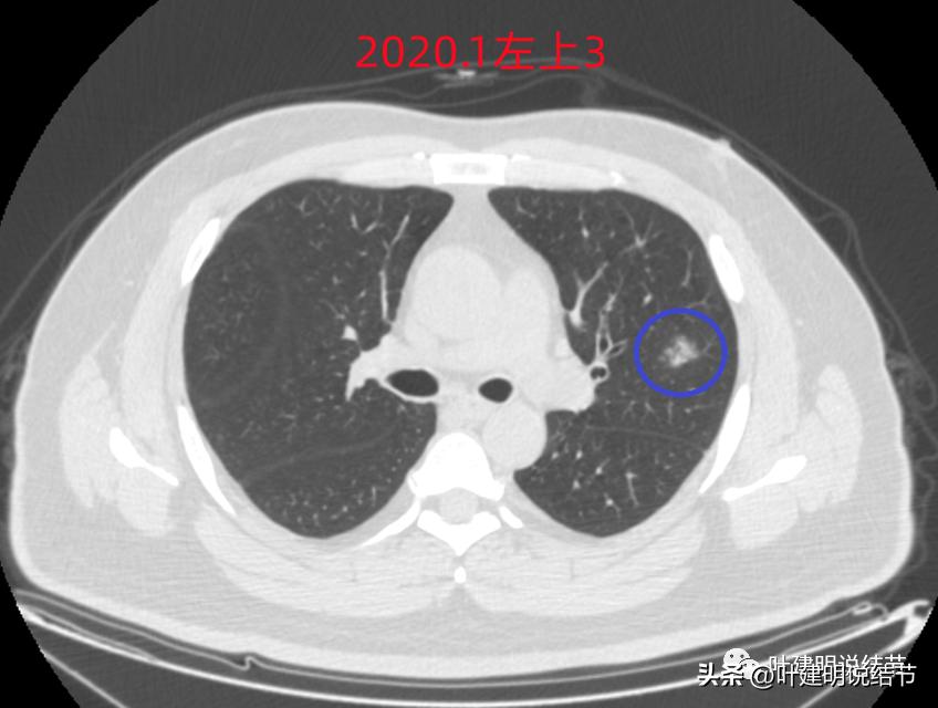 如何判断肺磨玻璃结节是高危结节,肺上有混合磨玻璃结节要注意什么