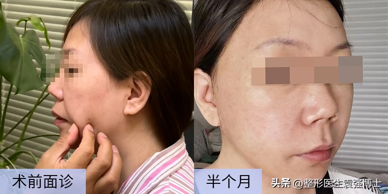 面部皮肤松弛形成口角囊袋,口角囊袋是皮肤松弛的结果吗