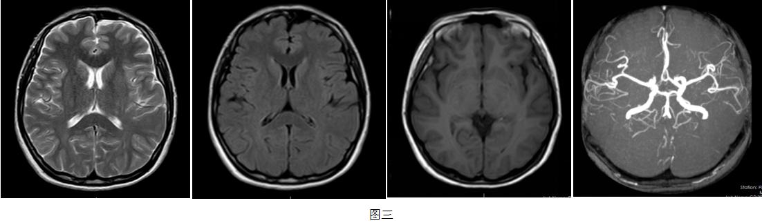 一打喷嚏头疼眼胀,一打喷嚏脑袋就疼是怎么回事